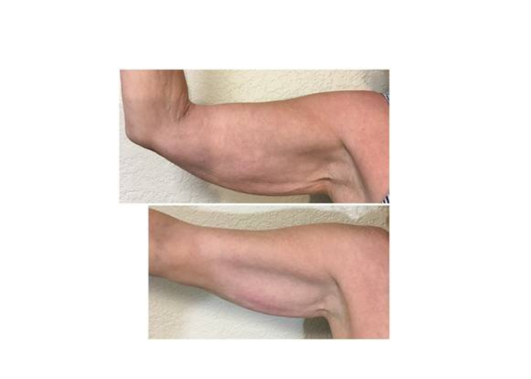 Before and after comparison of a woman's arm, showcasing significant changes in appearance and tone.