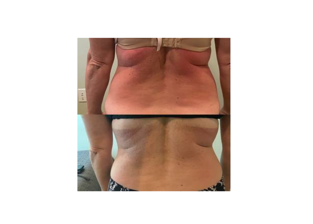Before and after photos showing a woman's tummy transformation, highlighting changes in shape and appearance.