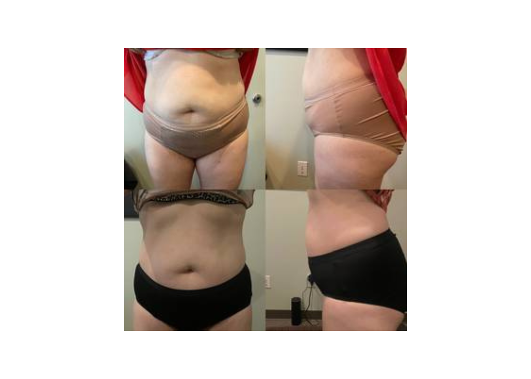 Before and after photos showing a woman's tummy transformation, highlighting changes in shape and appearance.