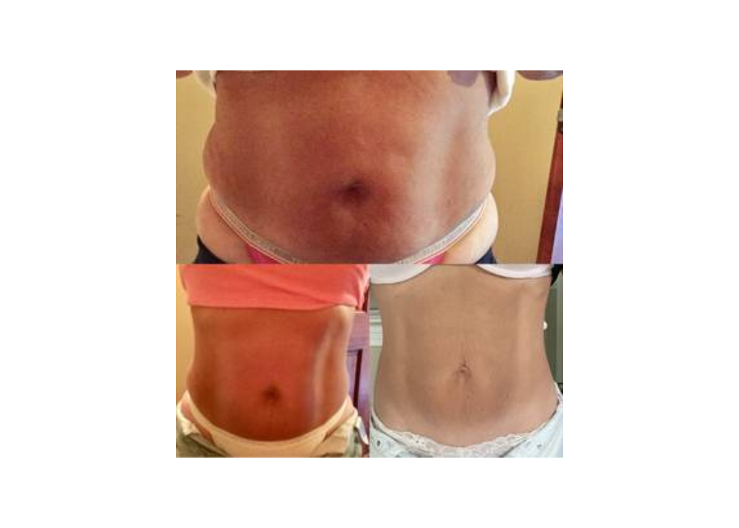 Comparison photos of a woman's tummy, depicting the visual changes from before to after a fitness or weight loss journey.