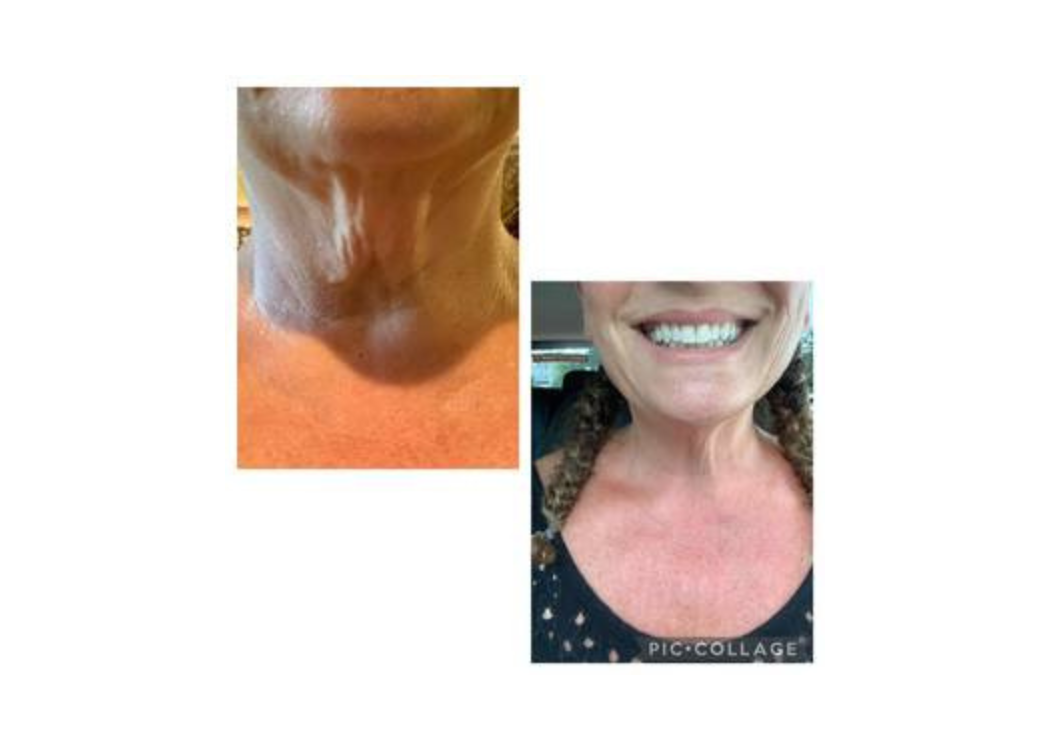 Before and after images of a woman showcasing the results of a neck lift procedure, highlighting improved neck contour.