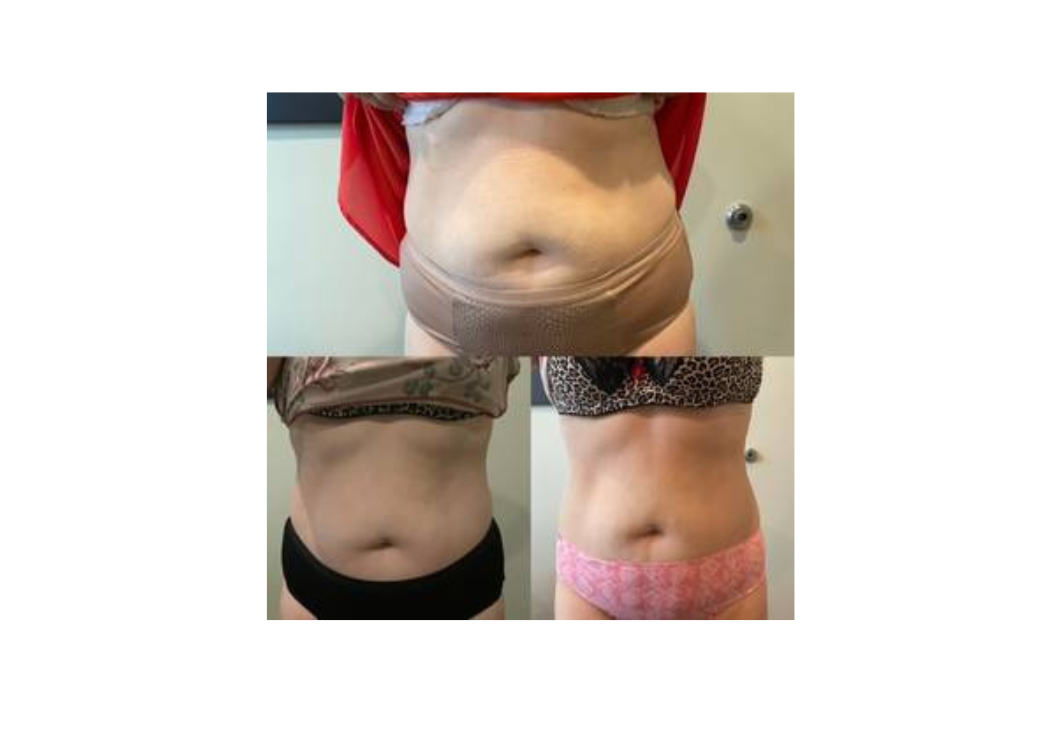 Before and after photos showing a woman's tummy transformation, highlighting changes in shape and appearance.